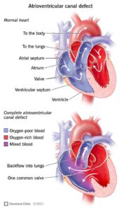 22173 atrioventricular canal defect illustration