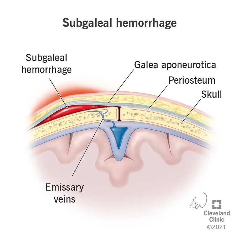 22219 subgaleal hemorrhage