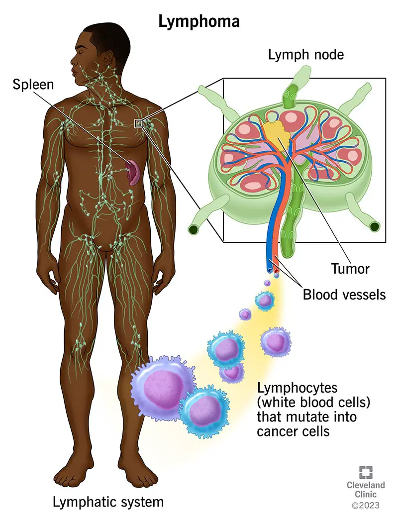 Limfoma ir vēzis, kas sākas jūsu baltajās asins šūnās (limfocītos).  Jums ir limfmezgli visā ķermenī.  Pietūkuši limfmezgli var būt limfomas pazīme jūsu limfmezglā.