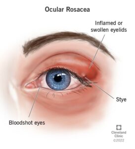 22265 ocular rosacea