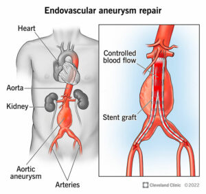 22291 endovascular aneurysm repair