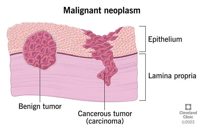 22319 malignant neoplasm