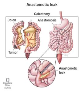 22324 anastomotic leak