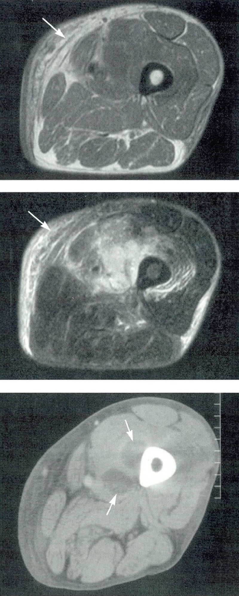 MRI attēli (divi augšējie attēli) parāda iekaisumu augšstilba audos.  CT skenēšana (attēls apakšā) parāda abscesu (piomiozītu), kas izveidojās netālu no augšstilba kaula (augšstilba kaula).