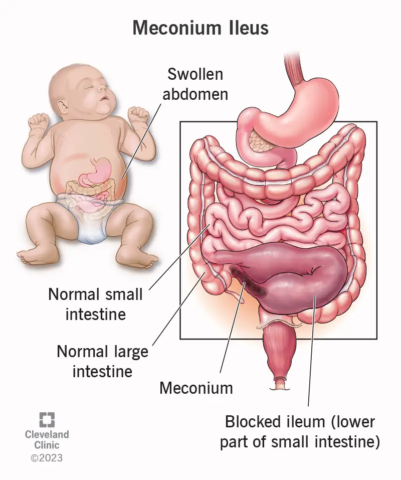 22448 meconium ileus