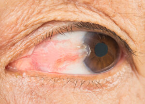 22497 pterygium