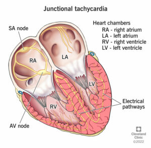 23216 junctional tachycardia