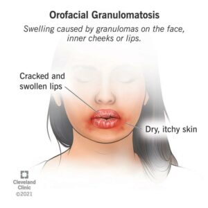 23317 orofacial granulomatosis