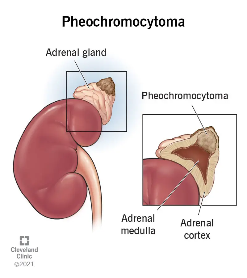 23373 pheochromocytoma