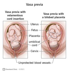 23465 vasa previa