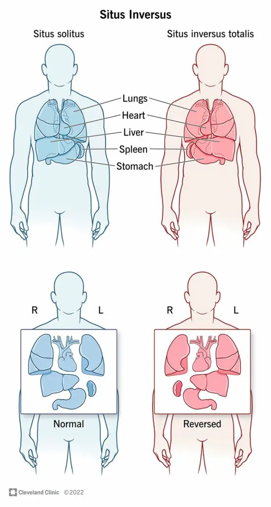 23486 situs inversus