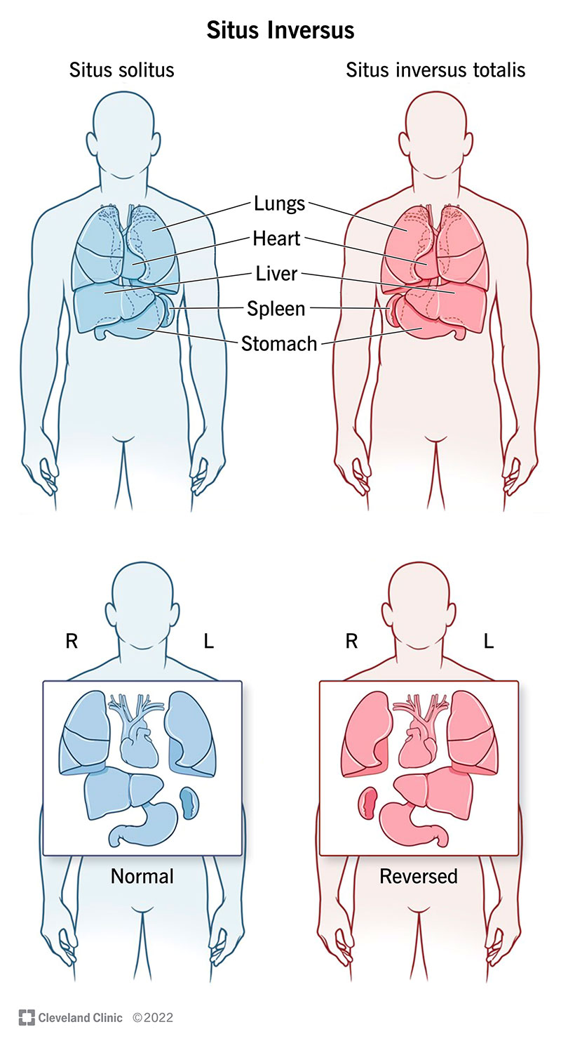 Situs inversus nozīmē, ka orgāni jūsu krūtīs un vēderā atrodas pretējā stāvoklī nekā normālai cilvēka anatomijai.