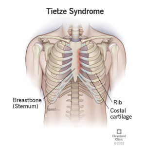 23565 tietze syndrome