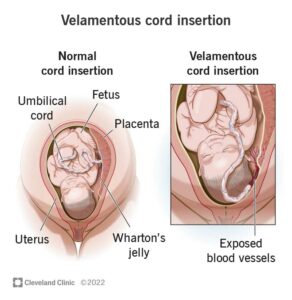 24111 velamentous cord insertion