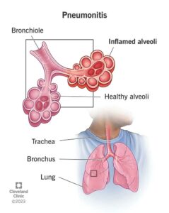 24810 pneumonitis