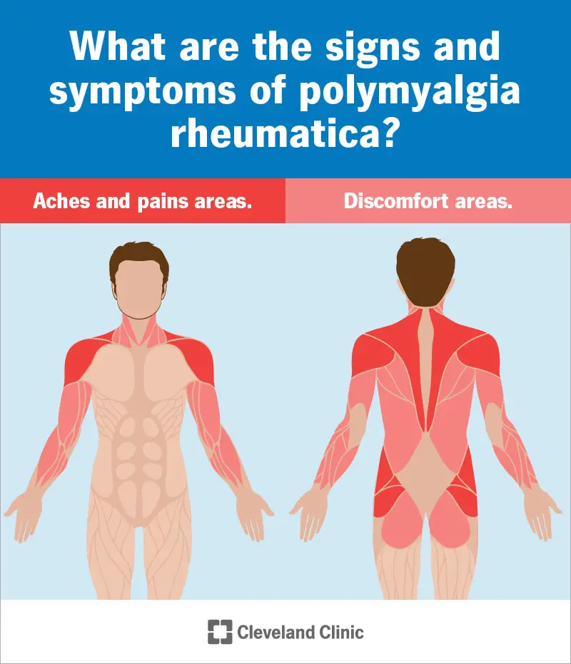 25215 polymyalgia rheumatica infographic