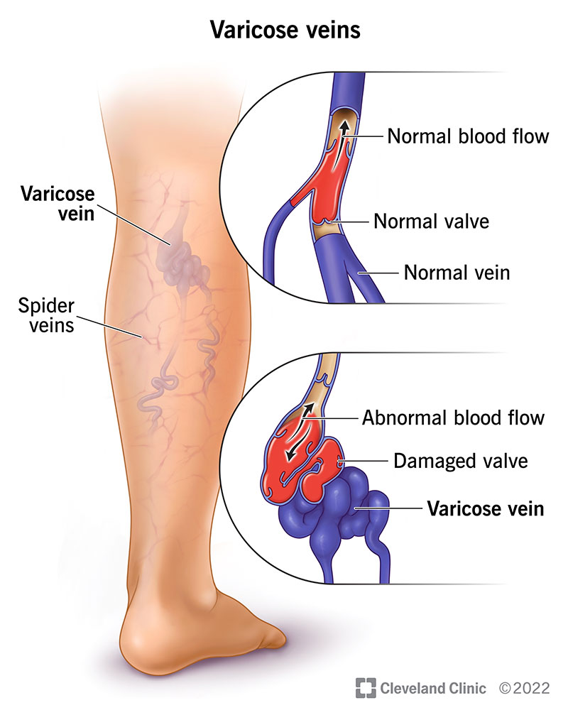 4722 varicose veins illustration