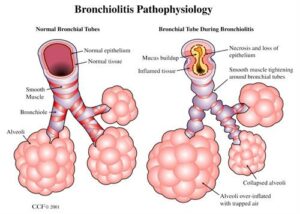 8272 pediatric bronchiolitis.ashx