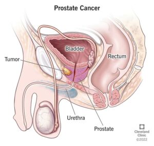 8634 prostate cancer