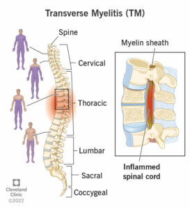 8980 transverse myelitis