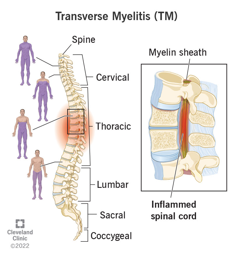 8980 transverse myelitis