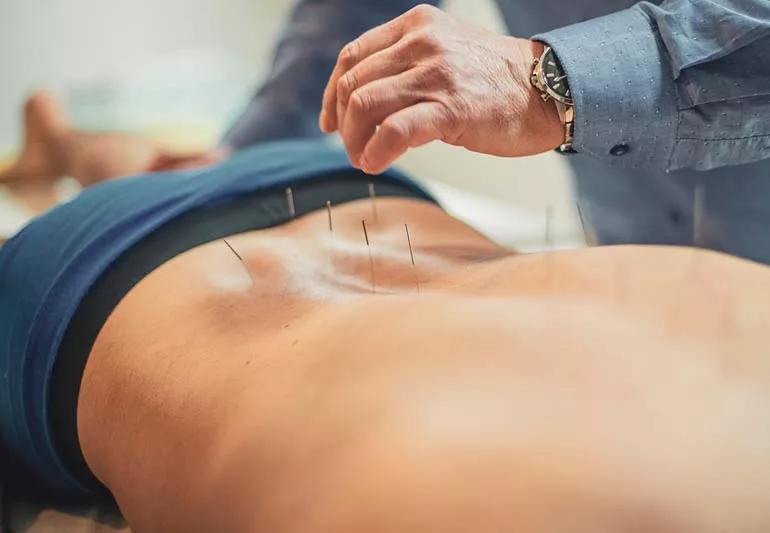 acupuncture Back 1251543001 770x533 1 jpg