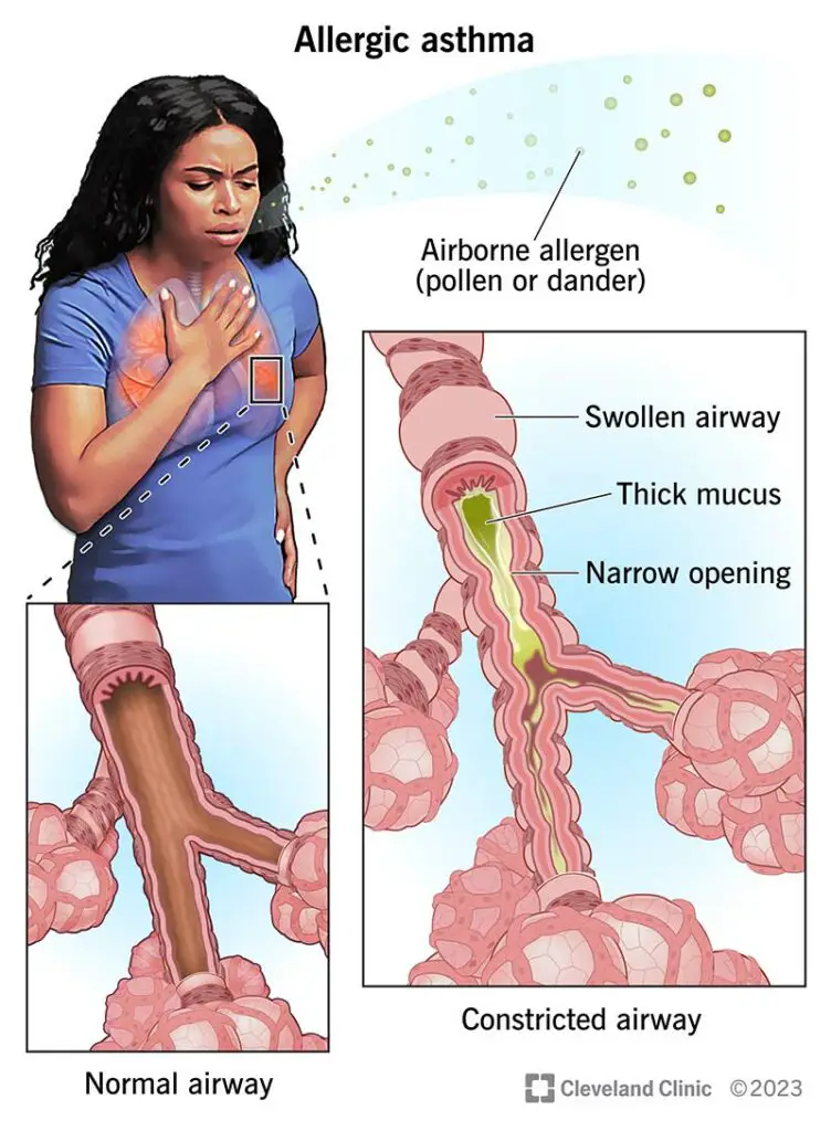 allergic asthma