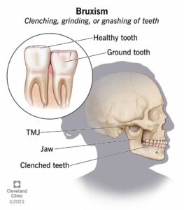 bruxism