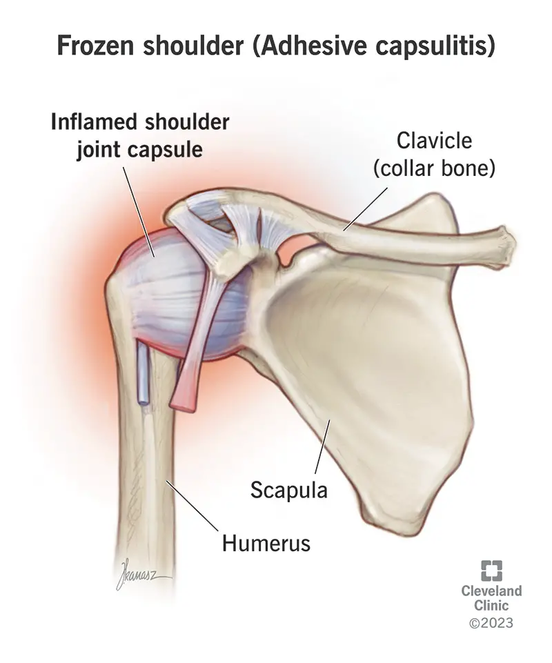 frozen shoulder