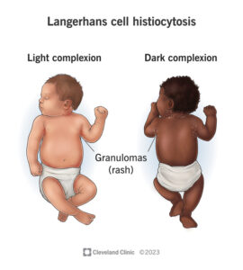 langerhans cel histiocytosis