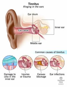 tinnitus