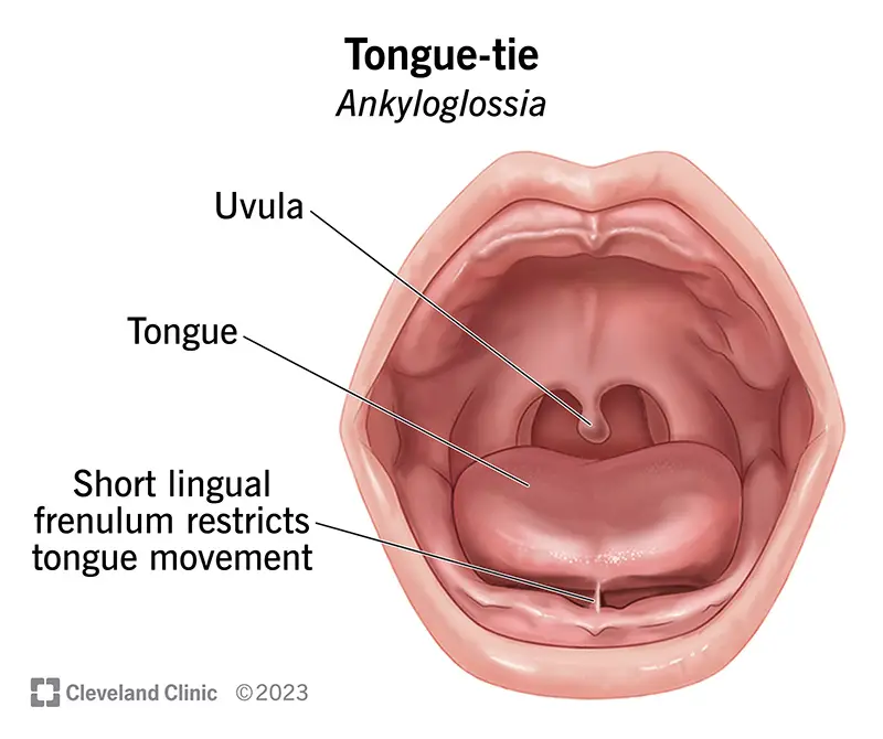 tongue tie ankyloglossia