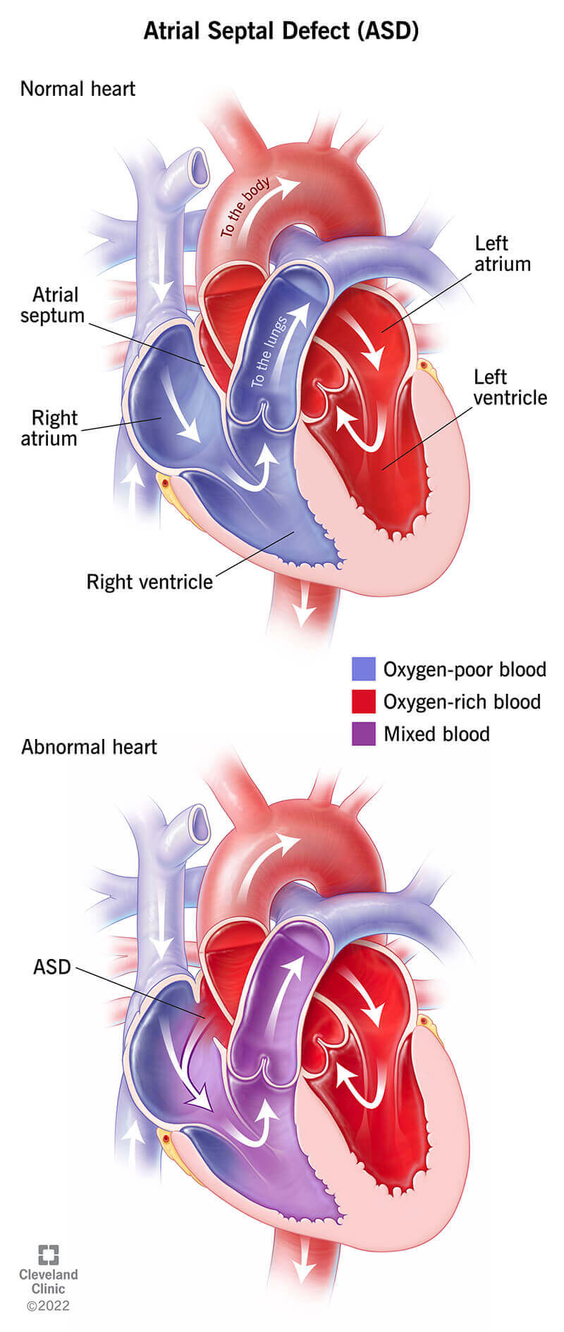 Ilustrācija, kurā salīdzināta normāla sirds ar sirdi, kurai ir priekškambaru starpsienas defekts.