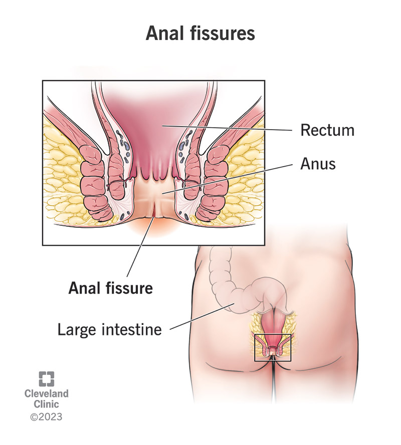 13177 anal fissures