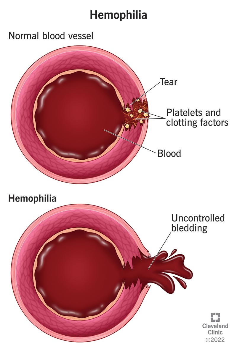 14083 hemophilia