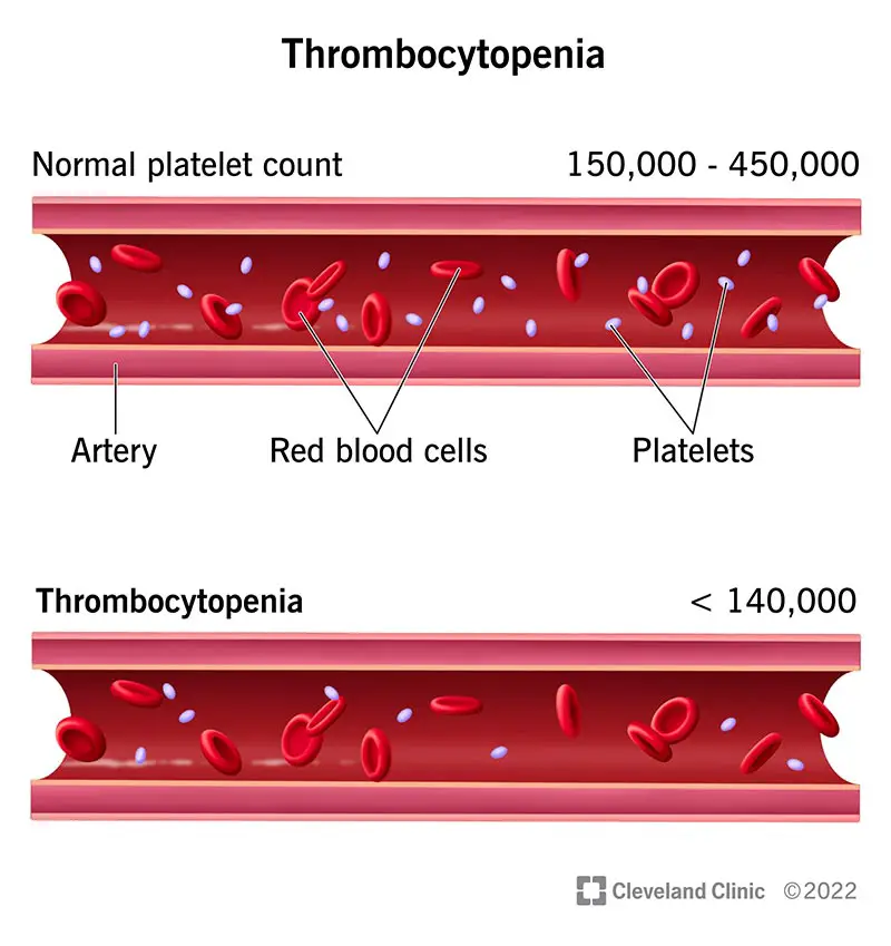 14430 thrombocytopenia