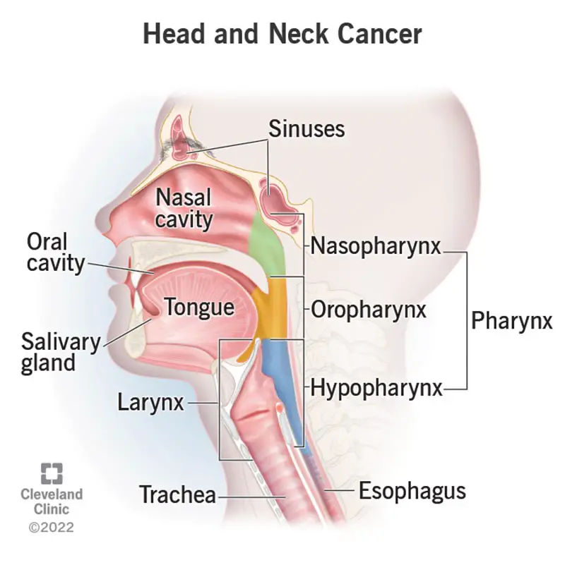 14458 head and neck cancer