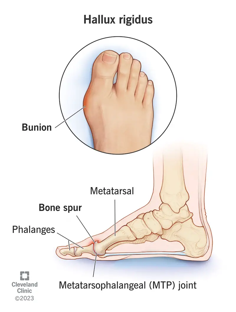 Ilustrācija, kurā attēlots bunion (hallux rigidus) uz cilvēka pēdas