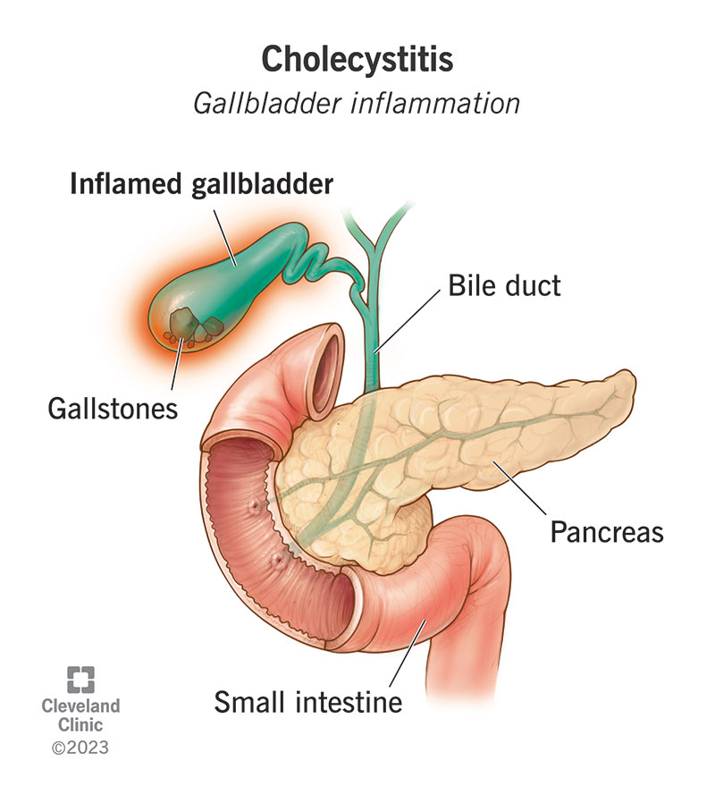 15265 cholecystitis gallbladder inflammation