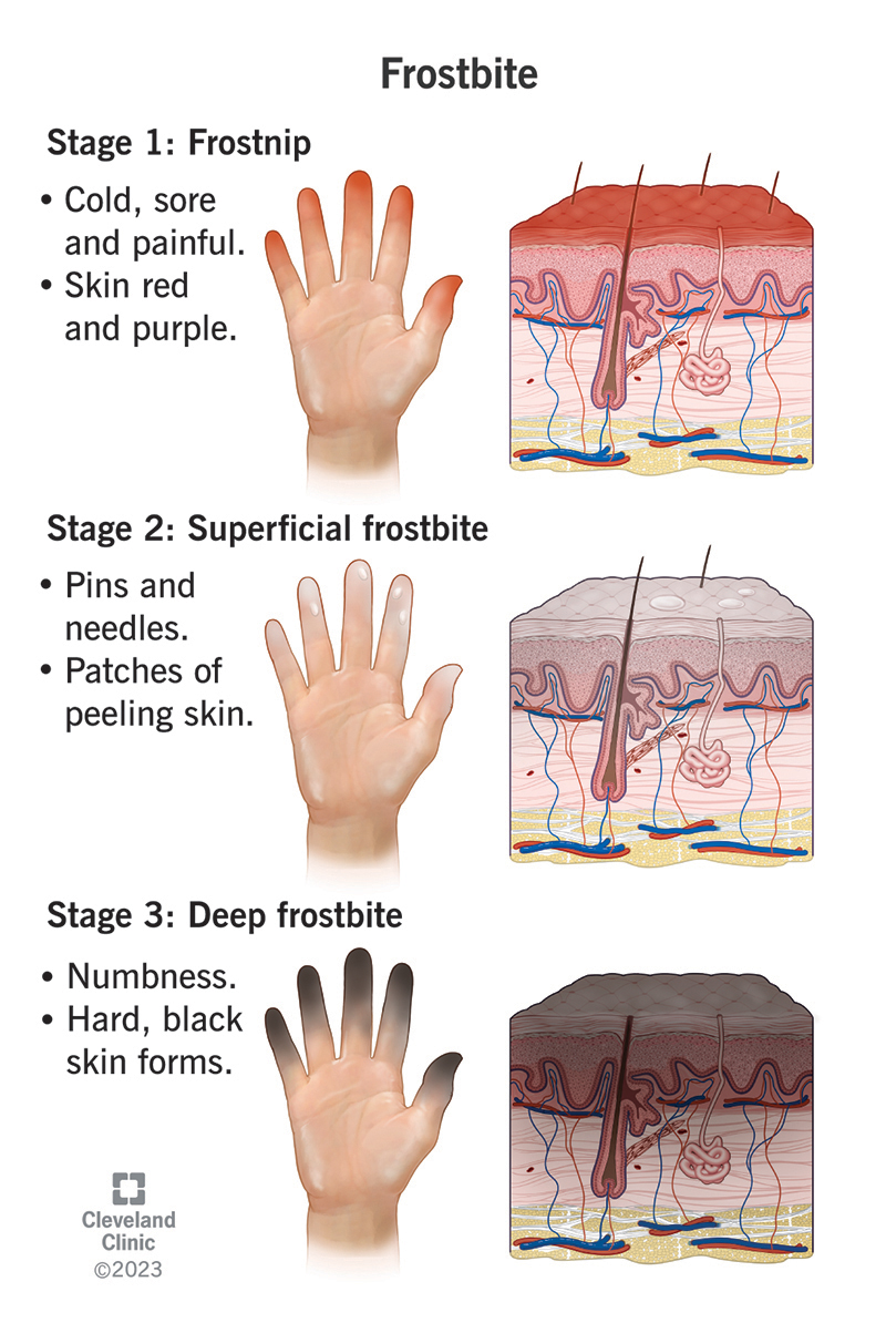 Trīs roku ilustrācijas ar trīs apsaldējuma stadiju aprakstiem.