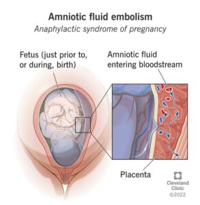 15463 amniotic fluid embolism