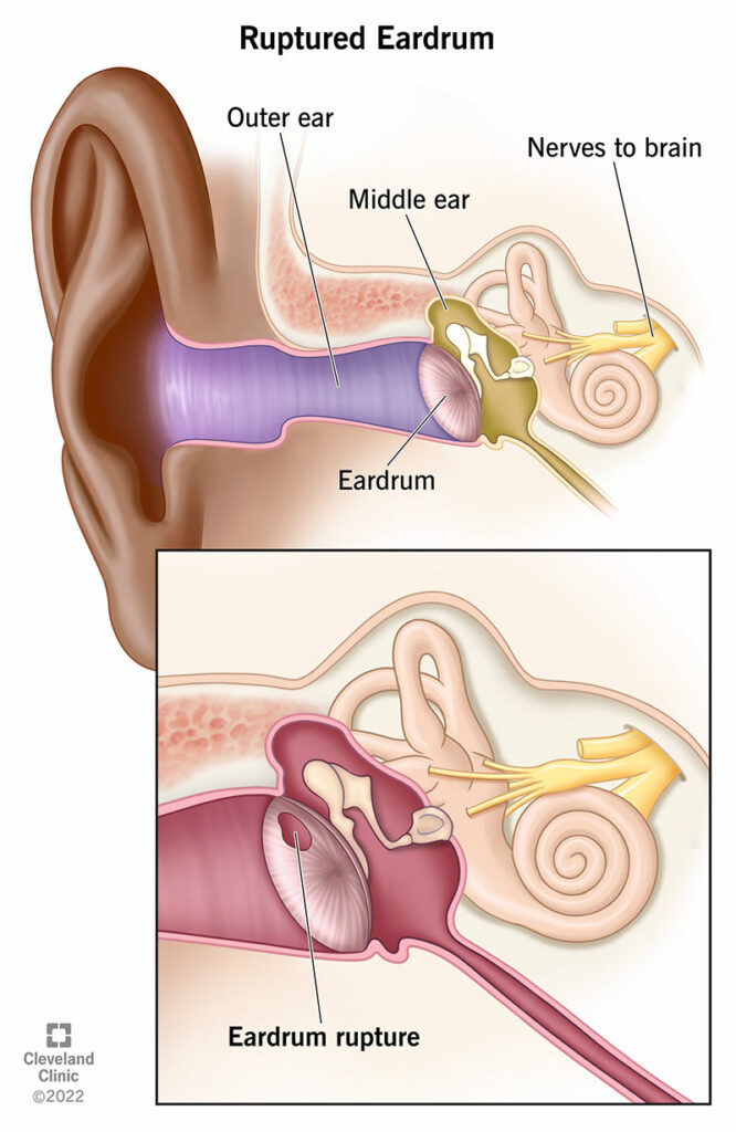 15581 ruptured eardrum