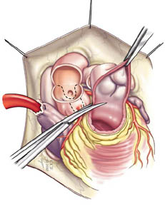 Medicīniskā ilustrācija, kurā parādīta vārstu pārbaude Ross procedūras ietvaros.