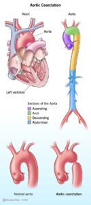 16876 aortic coarctation