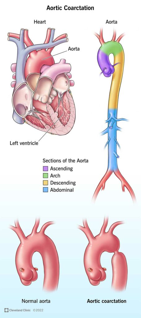 16876 aortic coarctation