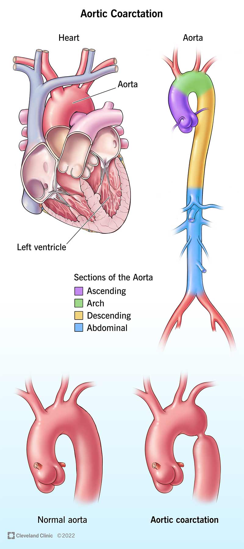 Ilustrāciju grupa, kas parāda sirds un aortas anatomiju.  Blakus esošie attēli parāda veselīgu aortu salīdzinājumā ar sašaurinātu aortu.