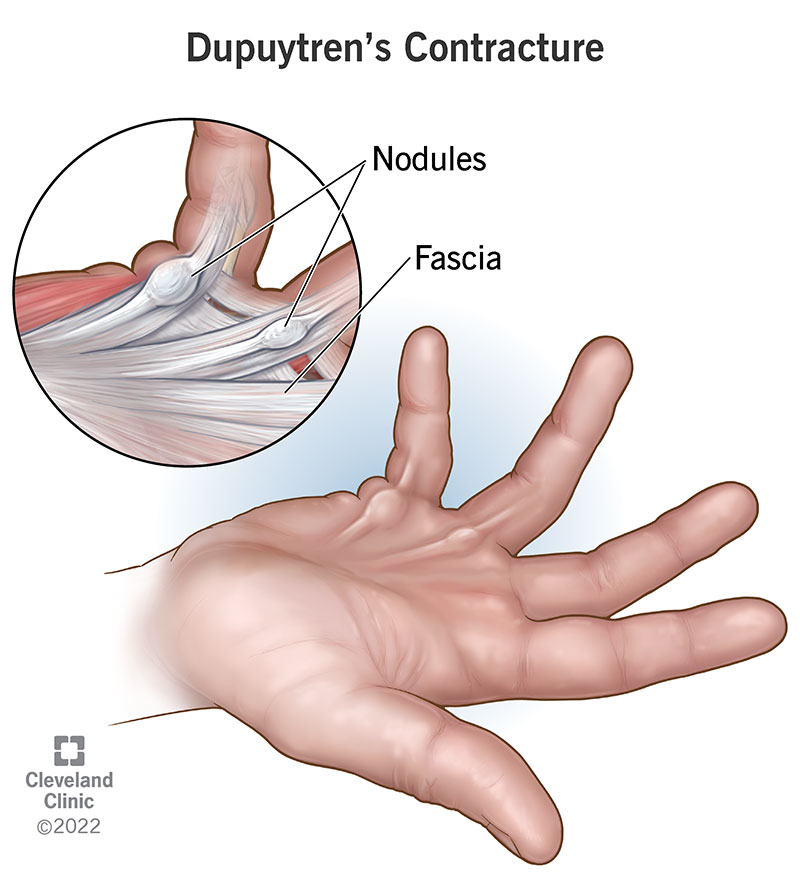 16941 dupuytrens contracture