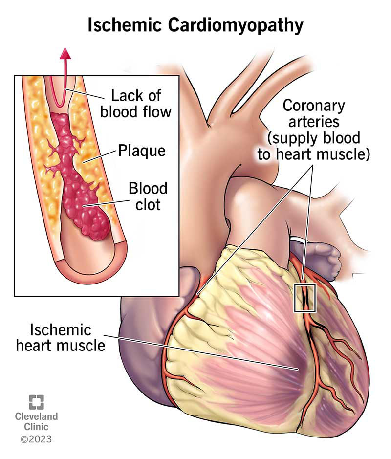 17145 ischemic cardiomyopathy illustration