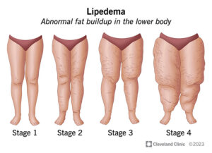 17175 lipedema illustration