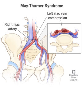 17213 may thurner syndrome